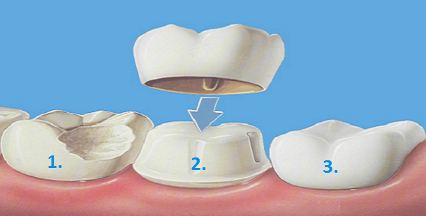 , Crowns in one appointment or two appointments?