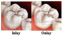 dental inlay onlay
