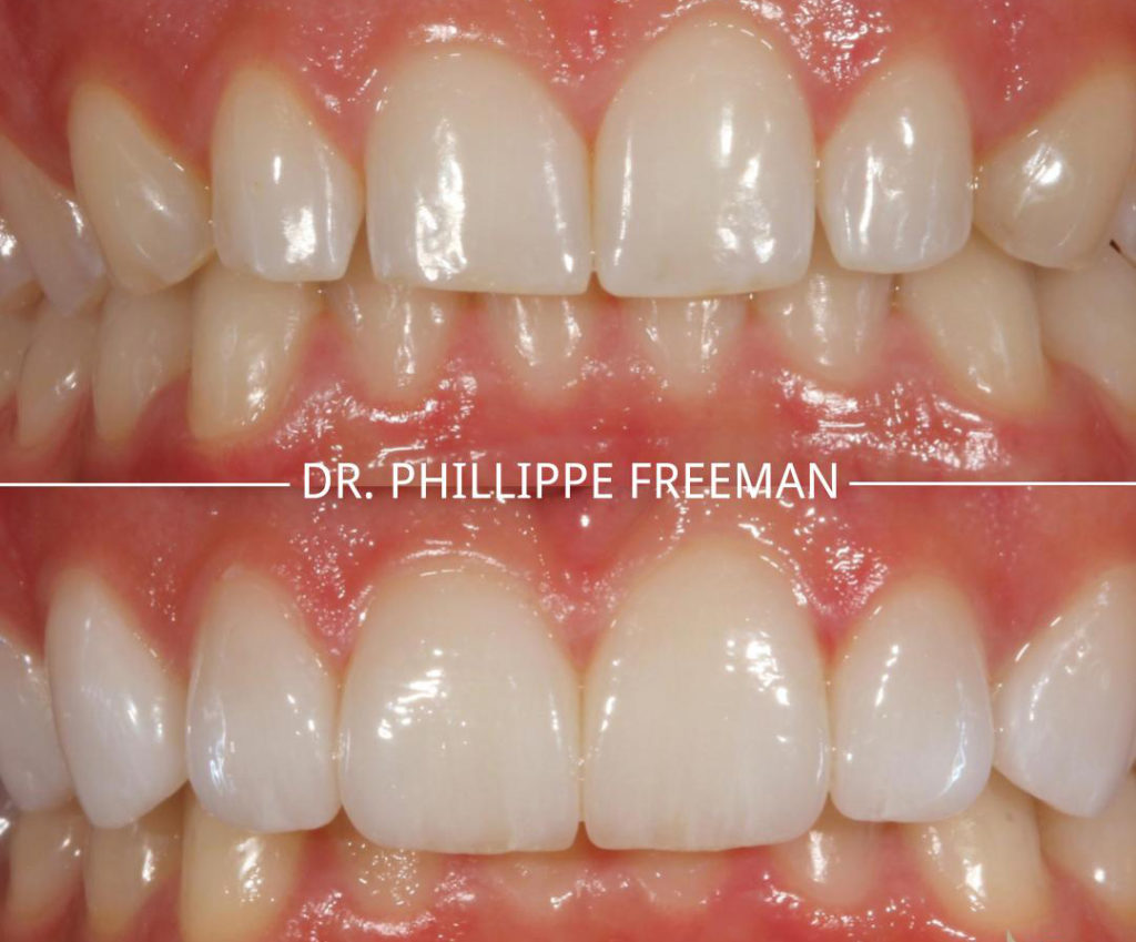 , Porcelain Veneers