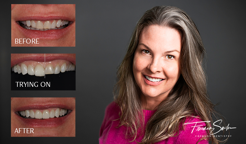 , Porcelain Veneers