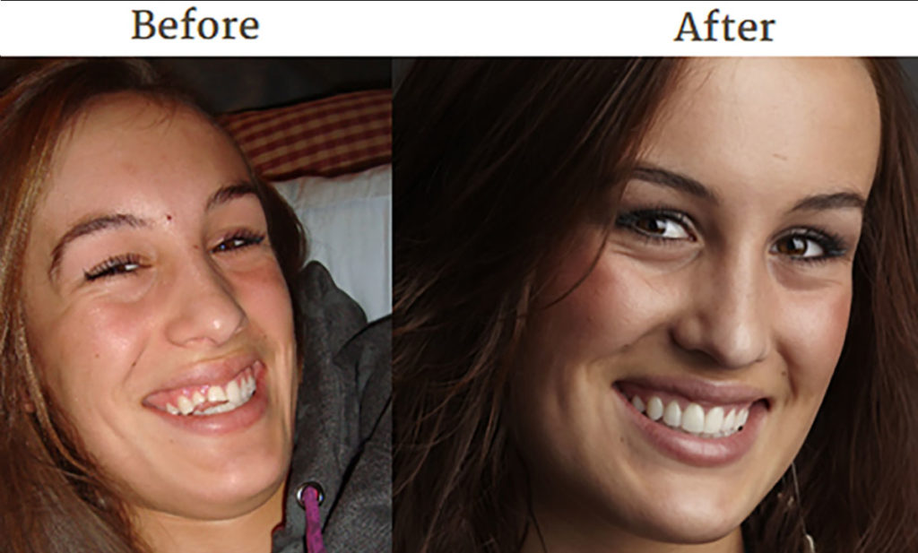 kelsey_before_after cosmetic dentistry experience results education, Top 3 Things to Consider When Choosing a Cosmetic Dentist