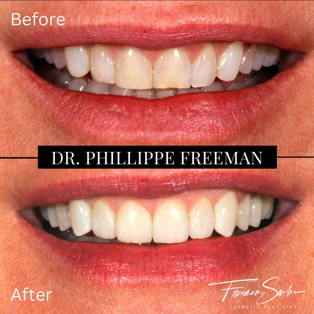 , Prepless Veneers