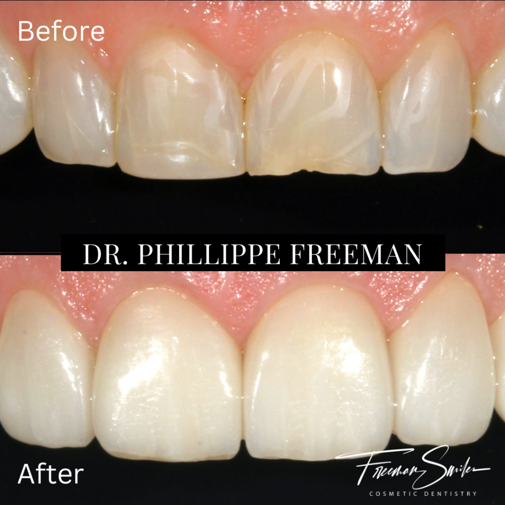 , Prepless Veneers
