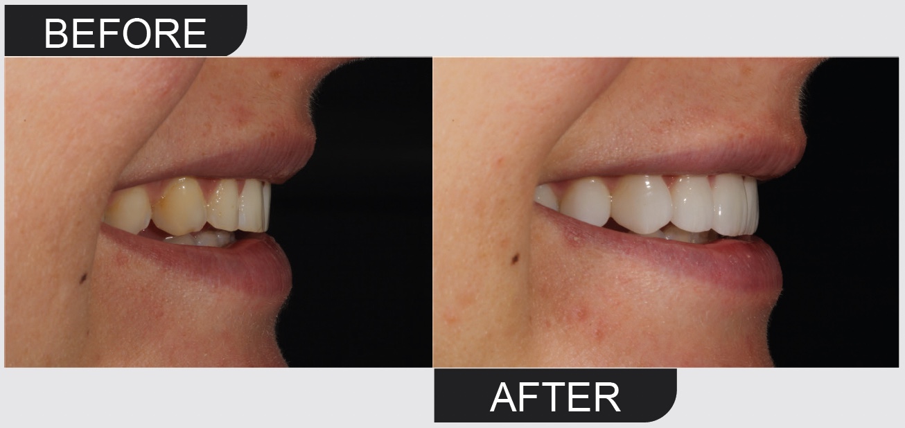 , Prepless Veneers