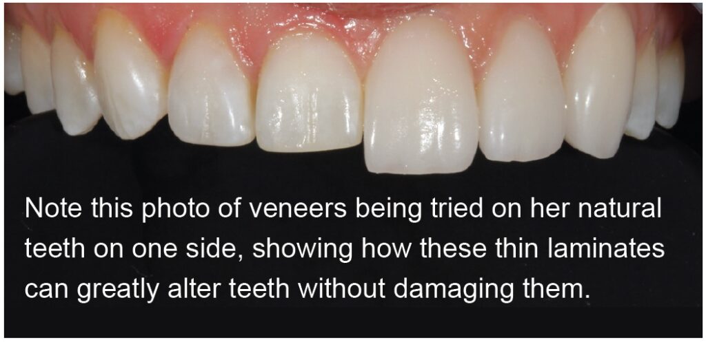 , Prepless Veneers