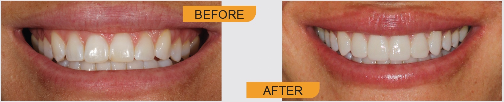 , Prepless Veneers